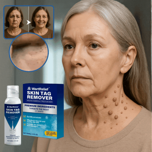 WartRelief™ Krem na kurzajki | Gładka, wolna od kurzajek skóra na zawsze – w 4 dni!