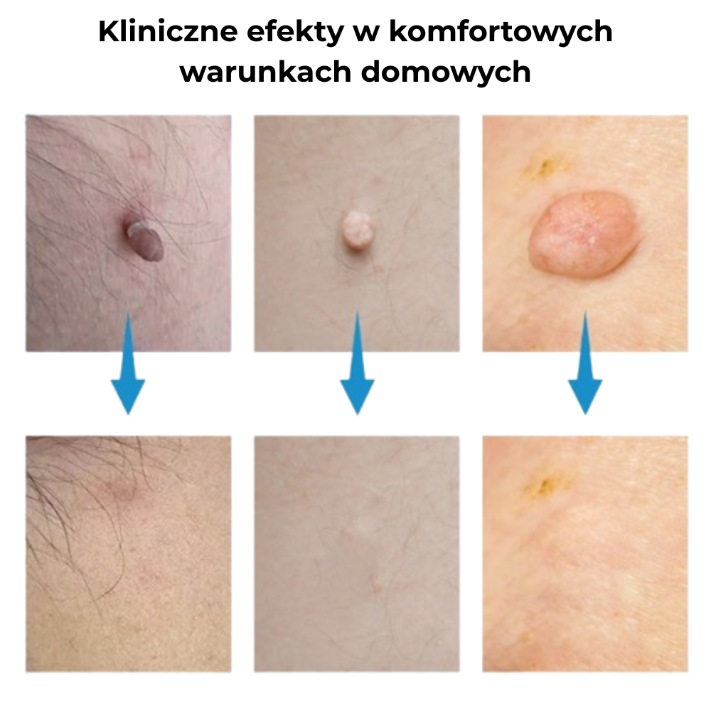 ClearTag™ - Usuwa włókniaki skórne w 7–10 dni