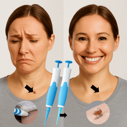 ClearTag™ - Usuwa włókniaki skórne w 7–10 dni