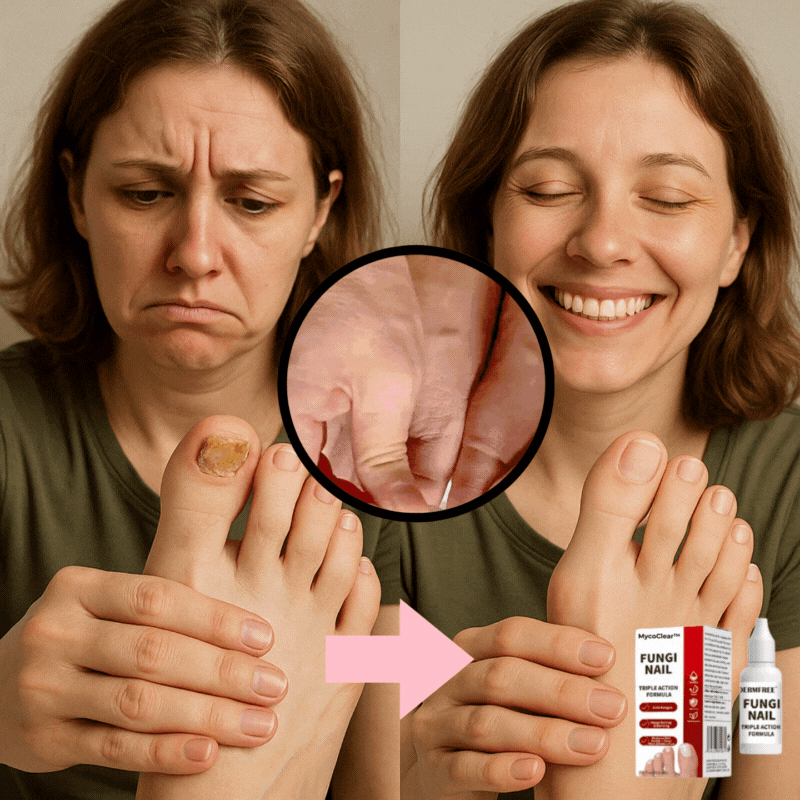 MycoClear™ Ultra Serum – pozbądź się grzybicy paznokci w 2 tygodnie | 1+1 GRATIS